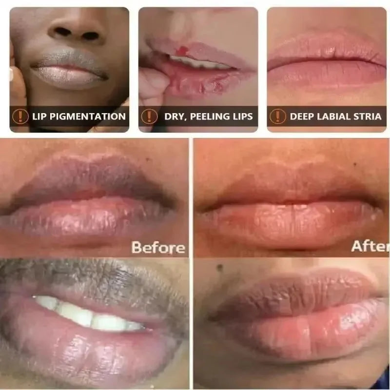 Remove Dark Lip Balm Lightening Melanin Mask