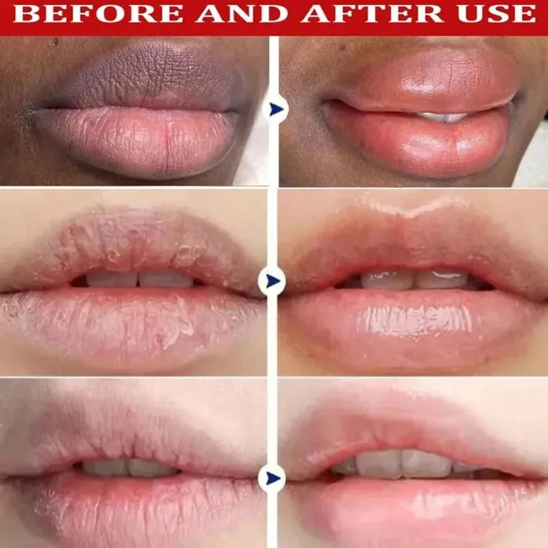 Remove Dark Lip Balm Lightening Melanin Mask