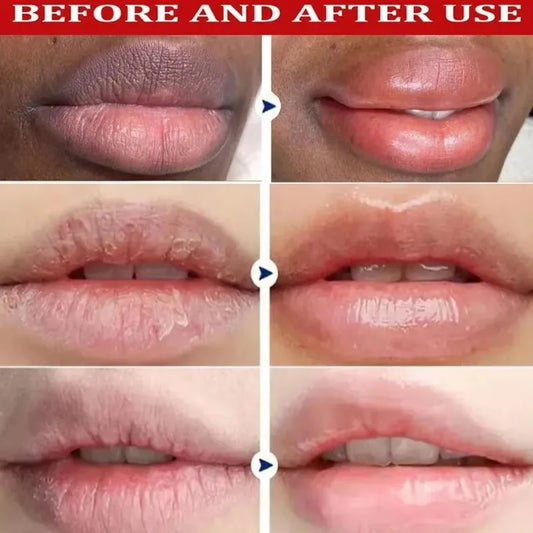 Remove Dark Lip Balm Lightening Melanin Mask
